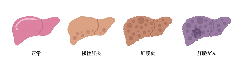 肝硬変が進行すると